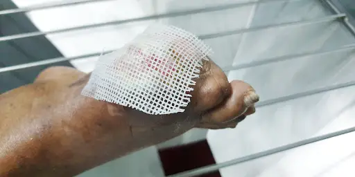 Tips for Healing Diabetic Wounds