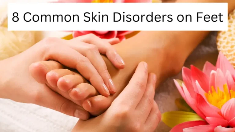 Unveiling 8 Common Skin Disorders On Feet And Treatments