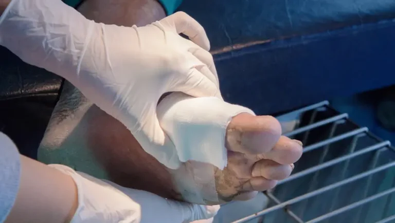 Diabetic Foot Ulcer: Causes, Prevention, and Treatment