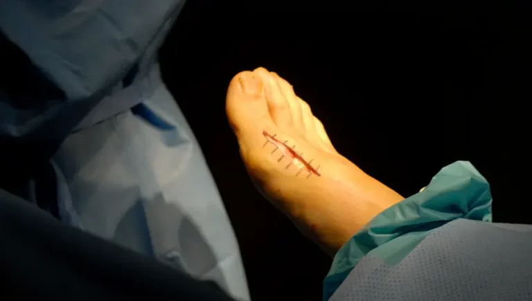 Can Screws Move After Bunionectomy Surgery? 