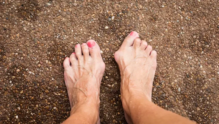 Effective Treatment For Hammertoes: Addressing The Root Of The Problem
