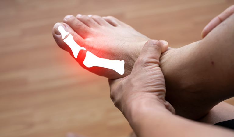 Don’t Let Arthritic Big Toe Joints Stop You in Your Tracks!