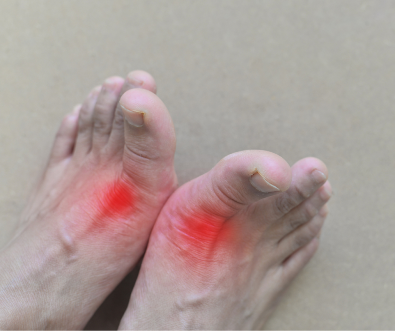 Senior Strategies: Managing Gout