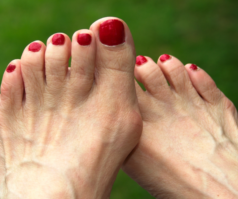 MIS Bunionectomy: Faster Recovery, Precise Results