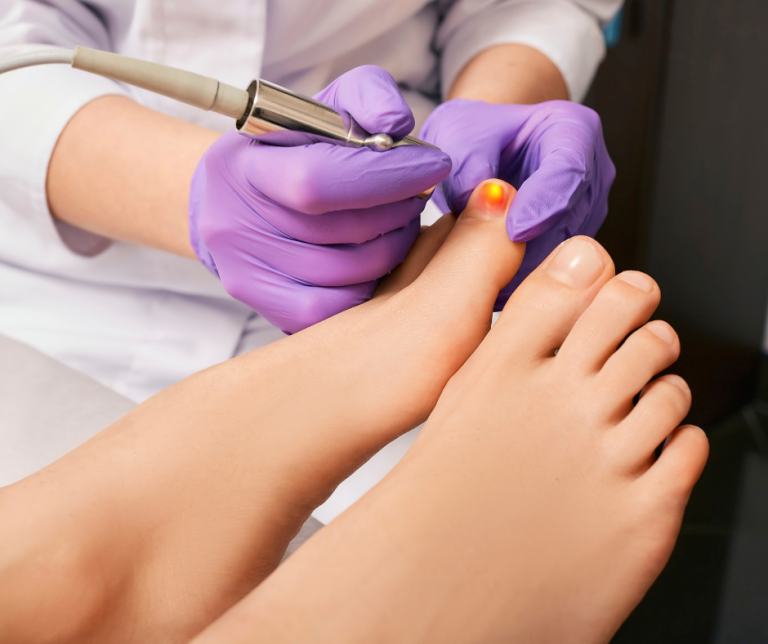 Get Rid of Toenail Fungus Once and For All With Non-Invasive Laser Treatments